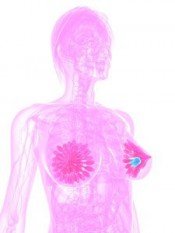 3d rendered illustration of tumor in transparent female breast
